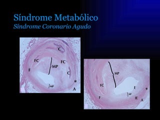 Síndrome Metabólico
Síndrome Coronario Agudo
 