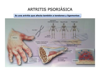 ¿Es la psoriasis una enfermedad de gente sana? #parapacientes