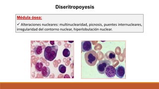 Diseritropoyesis
Médula ósea:
 Alteraciones nucleares: multinuclearidad, picnosis, puentes internucleares,
irregularidad del contorno nuclear, hiperlobulación nuclear.
 