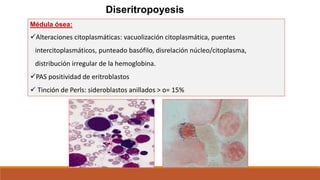 Diseritropoyesis
Médula ósea:
Alteraciones citoplasmáticas: vacuolización citoplasmática, puentes
intercitoplasmáticos, punteado basófilo, disrelación núcleo/citoplasma,
distribución irregular de la hemoglobina.
PAS positividad de eritroblastos
 Tinción de Perls: sideroblastos anillados > o= 15%
 