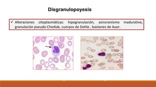 Disgranulopoyesis
 Alteraciones citoplasmáticas: hipogranulación, asincronismo madurativo,
granulación pseudo-Chediak, cuerpos de Dohle , bastones de Auer.
 Gold standard: granulocitos hipolobulados agranulares
 
