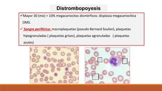 Distrombopoyesis
Mayor 30 (mo) = 10% megacariocitos dismórficos: displasia megacariocítica
OMS.
 Sangre periférica: macroplaquetas (pseudo Bernard Soulier), plaquetas
hipogranuladas ( plaquetas grises), plaquetas agranuladas ( plaquetas
azules)
 