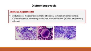 Distrombopoyesis
Valorar 30 megacariocitos
 Médula ósea: megacariocitos monolobulados, asincronismo madurativo,
núcleos dispersos, micromegacariocitos mononucleados (núcleo excéntrico y
redondo)
 Alteraciones de mayor grado: micromegacariocitos mononucleados,
megacariocitos hipolobulados; agrupación de micromegacariocitos
 