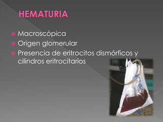  Macroscópica
 Origen glomerular
 Presencia de eritrocitos dismórficos y
  cilindros eritrocitarios
 