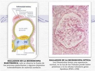 HALLAZGOS EN LA MICROSCOPIA ELECTRONICA : solo se observa la fusión de los procesos podocitarios y algunos depósitos subendoteliales de material rarefacto. HALLAZGOS EN LA MICROSCOPIA OPTICA : Los Glomérulos tienen una apariencia normal, en la luz de los Túbulos puede haber proteínas y en la células tubulares gotas lipoideas (PAS x 250)  