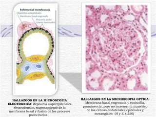 HALLAZGOS EN LA MICROSCOPIA ELECTRONICA : depósitos superepiteliales electrodensos, engrosamiento de la membrana basal y fusión de los procesos podocitarios  HALLAZGOS EN LA MICROSCOPIA OPTICA : Membrana basal engrosada y eosinofila, prominencia, pero no incremento numérico de las células endoteliales epiteliales y mesangiales  (H y E x 250)  