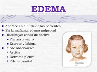 Aparece en el 95% de los pacientes. En la mañana: edema palpebral Distribuye: zonas de declive Piernas y sacro Escroto y labios. Puede observarse: Ascitis Derrame pleural Edema genital 