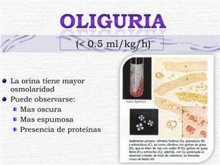 La orina tiene mayor osmolaridad Puede observarse: Mas oscura Mas espumosa Presencia de proteínas (< 0.5 ml/kg/h) 