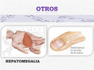 HEPATOMEGALIA 