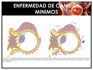 ENFERMEDAD DE CAMBIOS
       MINIMOS
 