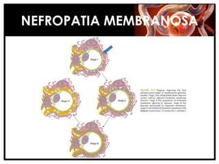 NEFROPATIA MEMBRANOSA
 