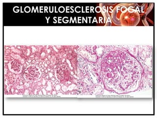 GLOMERULOESCLEROSIS FOCAL
     Y SEGMENTARIA
 