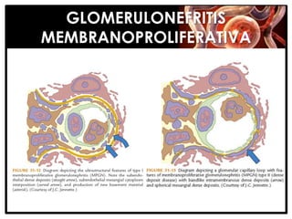 GLOMERULONEFRITIS
MEMBRANOPROLIFERATIVA
 