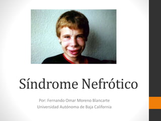 Síndrome Nefrótico
Por: Fernando Omar Moreno Blancarte
Universidad Autónoma de Baja California
 