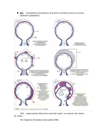  M.E: hay depósitos electrodensos de Ig entre la membrana basal y las células
epiteliales (subepitelial).
M.O: Engrosamiento difuso de la pared del capilar sin aumento del número
de células.
M.E: Depósitos Electrodenso lado epitelial MBG
 
