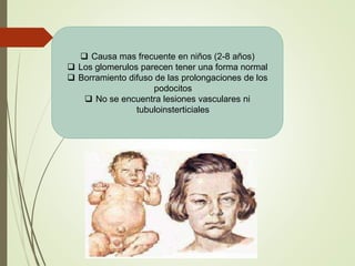  Causa mas frecuente en niños (2-8 años)
 Los glomerulos parecen tener una forma normal
 Borramiento difuso de las prolongaciones de los
podocitos
 No se encuentra lesiones vasculares ni
tubuloinsterticiales
 