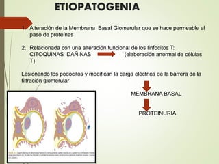 ETIOPATOGENIA
1. Alteración de la Membrana Basal Glomerular que se hace permeable al
paso de proteínas
2. Relacionada con una alteración funcional de los linfocitos T:
CITOQUINAS DAÑINAS (elaboración anormal de células
T)
Lesionando los podocitos y modifican la carga eléctrica de la barrera de la
filtración glomerular
MEMBRANA BASAL
PROTEINURIA
 