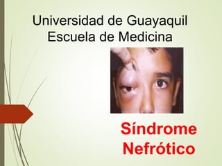 Síndrome
Nefrótico
Universidad de Guayaquil
Escuela de Medicina
 