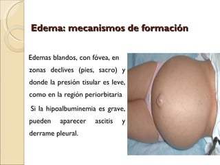 Edema: mecanismos de formación

Edemas blandos, con fóvea, en
zonas declives (pies, sacro) y
donde la presión tisular es leve,
como en la región periorbitaria
Si la hipoalbuminemia es grave,
pueden    aparecer    ascitis   y
derrame pleural.
 