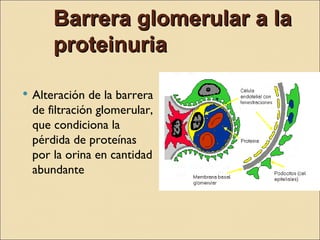 Barrera glomerular a la
        proteinuria

   Alteración de la barrera
    de filtración glomerular,
    que condiciona la
    pérdida de proteínas
    por la orina en cantidad
    abundante
 