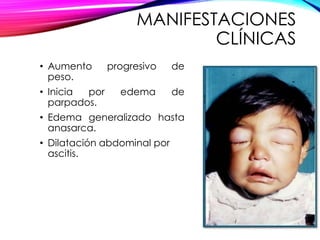 MANIFESTACIONES
CLÍNICAS
• Aumento progresivo de
peso.
• Inicia por edema de
parpados.
• Edema generalizado hasta
anasarca.
• Dilatación abdominal por
ascitis.
 
