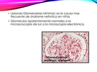 • Lesiones Glomerulares Minimas: es la causa mas
frecuente de sindrome nefrotico en niños
• Glomerulos aparentemente normales a la
microscocopia de luz a la microscopia electrónica.
 