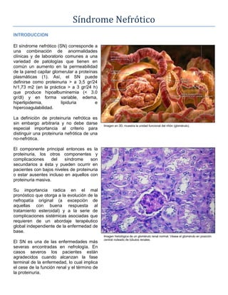 Síndrome Nefrótico<br />INTRODUCCION<br />2990850243205Imagen en 3D, muestra la unidad funcional del riñón (glomérulo).00Imagen en 3D, muestra la unidad funcional del riñón (glomérulo).El síndrome nefrótico (SN) corresponde a una combinación de anormalidades clínicas y de laboratorio comunes a una variedad de patologías que tienen en común un aumento en la permeabilidad de la pared capilar glomerular a proteínas plasmáticas (1). Así, el SN puede definirse como proteinuria > a 3,5 gr/24 h/1,73 m2 (en la práctica > a 3 gr/24 h) que produce hipoalbuminemia (< 3.0 gr/dl) y en forma variable, edema, hiperlipidemia, lipiduria e hipercoagulabilidad. <br />La definición de proteinuria nefrótica es sin embargo arbitraria y no debe darse especial importancia al criterio para distinguir una proteinuria nefrótica de una no-nefrótica.<br />299085050800Imagen histológica de un glomérulo renal normal. Véase el glomérulo en posición central rodeado de túbulos renales.00Imagen histológica de un glomérulo renal normal. Véase el glomérulo en posición central rodeado de túbulos renales.El componente principal entonces es la proteinuria, los otros componentes y complicaciones del síndrome son secundarios a ésta y pueden ocurrir en pacientes con bajos niveles de proteinuria o estar ausentes incluso en aquellos con proteinuria masiva.<br />Su importancia radica en el mal pronóstico que otorga a la evolución de la nefropatía original (a excepción de aquellas con buena respuesta al tratamiento esteroidal) y a la serie de complicaciones sistémicas asociadas que requieren de un abordaje terapéutico global independiente de la enfermedad de base. <br />El SN es una de las enfermedades más severas encontradas en nefrología. En casos severos los pacientes están agradecidos cuando alcanzan la fase terminal de la enfermedad, lo cual implica el cese de la función renal y el término de la proteinuria.<br />2990850381000El SN puede ocurrir en el contexto de una variedad de enfermedades primarias y sistémicas. En Adultos, aproximadamente un 30% de los casos presenta una enfermedad sistémica como Diabetes Mellitus, Amiloidosis o Lupus Eritematoso Sistémico. El resto de las causas corresponden en su mayoría a nefropatías primarias, principalmente glomerulonefritis membranosa (30-40%), glomeruloesclerosis focal y segmentaria (15-25%) y enfermedad por cambios mínimos (20%).<br />3000375467995PODOCITO NORMAL00PODOCITO NORMAL294322547053500Diversas neoplasias se asocian al SN. Los tumores sólidos generalmente se asocian a glomerulopatía membranosa, mientras linfomas y leucemias lo hacen con la enfermedad por cambios mínimos.<br />Por último, es importante señalar que distintas drogas como penicilamina, AINEs, sales de oro, captopril y otras también se asocian a la aparición del SN.<br />FISIOPATOLOGIA<br />La proteinuria en el SN se debe a un aumento en la permeabilidad de la pared capilar glomerular a macromoléculas circulantes. Normalmente la membrana capilar glomerular restringe el paso de estas macromoléculas sobre la base de tamaño y carga iónica. <br />3000375100965PODOCITO EN EL SN00PODOCITO EN EL SNEl ultrafiltrado glomerular debe atravesar (1) células endoteliales fenestradas, (2) la membrana basal glomerular (MBG) y (3) células epiteliales con sus podocitos.<br />La barrera en función de la carga iónica depende de la electronegatividad de la pared capilar, formada por cargas aniónicas presentes en las células endoteliales y especialmente en componentes aniónicos de la matriz extracelular localizados en la MBG (glucosaminoglicanos polianiónicos). Esta barrera normalmente restringe el paso de pequeñas proteínas polianiónicas (70-150 Å) como la albúmina.<br />La barrera en función del tamaño depende de poros ubicados en la MBG y diafragmas ubicados entre los podocitos de las células epiteliales que restringen el paso de proteínas mayores a 150 Å.<br />La proteinuria en la mayoría de las enfermedades glomerulares se debe a trastornos estructurales que aumentan el número de poros relativamente no selectivos. La pérdida parcial de la selectividad aniónica también puede contribuir en la pérdida de proteínas. La mayor excepción a este mecanismo, es la enfermedad por cambios mínimos, en la cual la pérdida de la barrera aniónica (aparentemente por disminución de la síntesis de polianiones a partir de las células epiteliales dañadas) es la mayor responsable del aumento en la filtración de proteínas.<br />La albúmina es la proteína que se pierde en mayor cantidad ya que es la proteína más abundante en el plasma, sin embargo también aumenta la excreción de una serie de otras proteínas plasmáticas.<br />Consecuencias y complicaciones:<br />Proteinuria <br />304800065405Si bien no suele considerarse como complicación, la proteinuria per sé tiene implicancias en términos de su capacidad de causar daño renal y por ende progresión hacia la insuficiencia renal. Estudios demuestran que el rango de pérdida de función renal en pacientes con proteinuria persistente se relaciona directamente con la magnitud de la misma. <br />Hipoalbuminemia <br />3037840115824000La concentración plasmática de albúmina disminuye como consecuencia de su pérdida en orina. La relación entre la magnitud de la proteinuria y la hipoalbuminemia es variable reflejando la influencia de la ingesta proteica, síntesis hepática de proteínas, catabolismo proteico y cambios en la distribución de la albúmina entre los compartimientos intra y extravascular.<br />La síntesis hepática de albúmina normalmente tiene la capacidad de aumentar a un rango de aproximadamente 25 g/día. No se sabe con certeza porqué pacientes que excretan 4-6 g de proteínas en 24 h no son capaces de incrementar la síntesis de albúmina para normalizar su concentración plasmática. Al mismo nivel de pérdida de albúmina, pacientes con SN tienen una albuminemia alrededor de 1 gr/dl menor que pacientes tratados con peritoneodiálisis continua. Aparentemente un aumento en el catabolismo renal de proteínas filtradas produce una pérdida mayor de albúmina que la estimada por su excreción en orina. <br />Existen pacientes con proteinuria en rango nefrótico que no presentan hipoalbuminemia importante, estos pacientes generalmente presentan formas secundarias de glomeruloesclerosis focal y segmentaria y no formas primarias. La liberación de citoquinas en estas últimas (FNTa, IL-1 por ej) podría suprimir directamente la síntesis hepática de albúmina.<br />Edema <br />397192540005Edema en región periorbitaria en el Síndrome nefrótico.0Edema en región periorbitaria en el Síndrome nefrótico.El edema es el síntoma que se presenta con más frecuencia en pacientes con SN. Típicamente desarrollan edema en extremidades inferiores, en región periorbitaria y tejido escrotal. También puede aparecer derrame pleural y ascitis. <br />Se han propuesto 2 teorías que explican la aparición de edema en estos pacientes. La teoría clásica o hipovolémica y la teoría de retención renal primaria de Sodio (Na).<br />La teoría clásica plantea que el edema es secundario a hipoalbuminemia y la disminución en la presión oncótica resultante. Esto favorecería la extravasación de líquido desde el compartimiento intravascular al intersticial, causando una disminución del volumen plasmático efectivo que estimularía mecanismos neurohormonales compensatorios (sistema simpático, eje renina-angiotensina-aldosterona y hormona antidiurética) favoreciendo la retención renal de Na y agua.<br />3971925886460Edema en miembros inferiores en el Síndrome nefrótico.Edema en miembros inferiores en el Síndrome nefrótico.Diversas observaciones van en contra de esta teoría. Es importante señalar que la retención de fluido en el compartimiento vascular no depende exclusivamente de la presión oncótica del plasma sino de la presión oncótica transcapilar (presión oncótica plasmática - presión oncótica intersticial). La presión oncótica del plasma es de aproximadamente 26 mmHg, mientras que la presión oncótica del intersticio es de 10 a 15 mmHg debido a la acumulación de pequeñas cantidades de albúmina filtradas normalmente a través de la pared capilar. La disminución de la presión oncótica del plasma en pacientes nefróticos produce una menor entrada de albúmina al intersticio y por ende una disminución en forma paralela de la presión oncótica intersticial. Como consecuencia, la gradiente transcapilar se mantiene relativamente constante a menos que la hipoalbuminemia sea aguda o muy severa. <br />Más aún, pacientes con SN generalmente presentan volumen plasmático normal o aumentado. La hipertensión arterial asociada a fases de proteinuria nefrótica también es consistente con hipervolemia.<br />El bloqueo farmacológico del sistema renina-angiotensina-aldosterona puede no aumentar la natriuresis, respuesta esperable si la retención de Na fuese consecuencia de un aumento compensatorio de este sistema.<br />Estudios en modelos animales sugieren que la retención de Na en estos pacientes se debe a una mayor reabsorción en túbulos colectores (sitio de acción del péptido natriurético auricular (PNA)).<br />Pacientes nefróticos presentan niveles plasmáticos de PNA muy superiores a pacientes no nefróticos ingiriendo la misma cantidad de Na. Estudios tanto animales como humanos han demostrado resistencia a la acción del PNA, la que se debería en parte a un aumento en al actividad de la fosfodiesterasa en los túbulos colectores. Esto produce mayor degradación del segundo mensajero del PNA, el GMP cíclico. Inhibidores de la fosfodiesterasa revierten estos efectos y restablecen la respuesta normal al PNA.<br />Hiperlipidemia y lipiduria <br />Existe un aumento variable en las concentraciones de VLDL, IDL y LDL en pacientes con SN, resultando en un aumento de la concentración plasmática de colesterol ya sea en forma aislada o en conjunto con un aumento en la concentración plasmática de triglicéridos. La fracción HDL en general se mantiene normal pero sus subtipos se distribuyen en forma anormal, con disminución del subtipo HDL2 y aumento del HDL3. <br />El perfil lipídico resultante es un perfil altamente aterogénico.<br />28333706604000Existen tres mecanismos principales que explican la hiperlipidemia: <br />1. aumento en la síntesis hepática de lipoproteínas.<br />2. disminución del catabolismo lipídico.<br />3. disminución del clearence de lipoproteínas mediado por receptores. <br />La hipercolesterolemia se debería principalmente a un aumento en la síntesis hepática de lipoproteínas que contienen colesterol y lipoproteína B. Esto ha sido documentado in vivo en ratas nefróticas. El hígado de éstas muestra hipertrofia, aumento en la concentración tisular de colesterol y en la actividad de la enzima 3-hidroxi 3-metilglutaril-CoA reductasa (HMG-CoA reductasa).<br />El estímulo que gatilla el aumento en la síntesis hepática de lipoproteínas no es totalmente conocido, aunque parece estar relacionado directamente con la hipoalbuminemia ya que infusiones de albúmina normalizan los lípidos y lipoproteínas plasmáticas. Sin embargo, otras macromoléculas oncóticamente activas son igualmente efectivas, lo que sugiere que una disminución en la presión oncótica sería el estímulo más importante. Más aún, la severidad de la hiperlipidemia se relaciona en forma inversa con la caída en la presión oncótica.<br />Un aumento en la síntesis hepática de otras proteínas puede jugar un rol importante en el desarrollo de hiperlipidemia. Por ejemplo, el aumento en la síntesis de la enzima colesteril ester transferasa (CETP) que normalmente transfiere colesterol esterificado desde HDL a lipoproteínas ricas en triglicéridos (VLDL, IDL).<br />Numerosas observaciones demuestran que una disminución del catabolismo lipídico parece jugar un rol aún más importante en la hiperlipidemia de pacientes con SN.<br />Es probable que la pérdida urinaria o la disminución de la actividad de alguna sustancia implicada en el catabolismo renal aún no identificada sea el factor preponderante.<br />Por ejemplo se ha demostrado disminución en la actividad de la Lipoproteinlipasa (LPL) en pacientes con SN. La albúmina aumenta la actividad de esta enzima al unirse a ácidos grasos libres (producto de la hidrólisis lipoproteica) por lo que la hipoalbuminemia podría causar una acumulación de ácidos grasos libres que inhiban la acción de esta enzima. La pérdida urinaria de un cofactor de esta enzima también podría contribuir.<br />También se aprecia disminución de la actividad de otra enzima clave en el catabolismo lipoproteico, la enzima Lecitin Colesterol Transferasa (LCAT). La albúmina también se une a un producto de la reacción de esta enzima (lisolecitina) por lo que su acumulación podría inhibir su actividad. La pérdida urinaria de LCAT también juega un rol importante.<br />Lipiduria usualmente está presente en el SN. La filtración de lipoproteínas es mínima en sujetos normales pero está francamente aumentada cuando aumenta la permeabilidad glomerular a macromoléculas. Así, la lipiduria es prácticamente patognomónica de enfermedad glomerular con la única excepción de la enfermedad poliquística.<br />La hiperlipidemia en pacientes nefróticos tiene implicancias clínicas importantes. El perfil lipídico que se observa en estos pacientes es un perfil altamente aterogénico.<br />La coexistencia de hipertensión arterial e hipercoagulabilidad hace difícil precisar el rol de la hiperlipidemia por sí sola en el aumento del riesgo de enfermedad coronaria pero a su vez crean una creciente preocupación respecto a la alta incidencia de patología cardiovascular en estos pacientes.<br />Se ha demostrado un riesgo relativo de 5,5 en cuanto a mortalidad por enfermedad coronaria, 2,5 respecto a la posibilidad de desarrollar enfermedad coronaria y 5,3 de presentar un infarto agudo al miocardio en comparación con pacientes controles. Incluso en población pediátrica la incidencia de enfermedad ateroesclerótica es especialmente alta.<br />Una segunda preocupación es la capacidad de la hiperlipidemia de aumentar la injuria renal y promover la progresión hacia la insuficiencia renal. Los lípidos pueden contribuir directamente a la injuria glomerular y túbulointersticial.<br />Estudios en modelos animales alimentados con dietas ricas en colesterol, muestran el desarrollo de hiperlipidemia, proteinuria y glomeruloesclerosis. Los lípidos se depositan en el riñón enfermo tempranamente en el curso de la enfermedad renal. El depósito promueve la infiltración mononuclear. Monocitos que infiltran el mesangio se diferencian en macrófagos que ingieren los lípidos depositados transformándose en células espumosas. Estas células liberarían mediadores inflamatorios que modifican la función glomerular.<br />Las moléculas de LDL además aumentan la síntesis de componentes de la matriz. Moléculas de LDL oxidadas son citotóxicas para las células mesangiales y estimulan la producción de tromboxano A2, un potente vasoconstrictor. En ratas, las anormalidades hemodinámicas asociadas con hiperlipidemia son revertidas por un antagonista del receptor de tromboxano. <br />A pesar de esto, la mayoría de los pacientes con hiperlipidemia primaria no desarrollan enfermedad glomerular. Esto sugiere que cuando la función renal es normal el riñón está protegido de la injuria mediada por lípidos.<br />En resumen, una vez iniciado el daño glomerular, la acumulación de lípidos en el mesangio puede iniciar una respuesta inflamatoria crónica con infiltración de macrófagos, muerte de células mesangiales y acumulación excesiva de componentes de la matriz. Estos eventos son similares a aquellos que transforman estrías grasas en placas fibrosas en la pared arterial.<br />Hipercoagulabilidad y tromboembolismo <br />39166805016500Pacientes con SN tienen una elevada incidencia de complicaciones tromboembólicas arteriales y venosas (10-50%), particularmente trombosis de vena renal (TVR), la que se presenta con mayor frecuencia en pacientes con glomerulopatía membranosa (20-30%) y glomerulonefritis membranoproliferativa. <br />Se han descrito una serie de anormalidades hemostáticas que conducen a un estado de hipercoagulabilidad. Los mecanismos que la producen pueden dividirse en dos grandes grupos: <br />1. Síntesis aumentada de factores procoagulantes, entre los que destaca el aumento del fibrinógeno (que se relaciona directamente con la mayor síntesis de albúmina), Factor V y Factor VIII.<br />2. Pérdida urinaria de factores anticoagulantes, especialmente de antitrombina III, aunque también se ha descrito disminución de la actividad de la proteína C y S, plasminógeno, antiplasmina y del Factor XII.<br />Existe además trombocitosis y un aumento de la agregación plaquetaria. Esta última se relaciona inversamente con la concentración plasmática de albúmina y revierte tras infusiones de ésta. La albúmina se une al ácido araquidónico y limita su conversión a tromboxano, un potente estimulador de la agregación plaquetaria. Un aumento en la producción de tromboxano puede contribuir a la hiperagregabilidad plaquetaria.<br />Otra posibilidad es que la injuria inmune en el glomérulo resulte en un aumento de la actividad procoagulante. La TVR es más común en pacientes con glomerulopatía membranosa y glomerulonefritis membranoproliferativa, la incidencia es mucho menor en pacientes con enfermedad por cambios mínimos, glomeruloesclerosis focal y Amiloidosis, en los cuales la formación de complejos inmunes no juega un rol.<br />No existen indicadores confiables del riesgo individual de hacer una complicación tromboembólica, pero una albuminemia menor a 2,5 g/dl, proteinuria mayor a 10 g/24 h, niveles de fibrinógeno aumentados, antitrombina III menor a 75% e hipovolemia se asocian significativamente a un riesgo mayor.<br />Trombosis de Vena Renal (TVR) <br />2743200666750Diversos factores están implicados en la génesis de esta complicación en pacientes con SN.<br />Además del estado de hipercoagulabilidad, una disminución del flujo a través del glomérulo y por ende, hemoconcentración en la circulación postglomerular podría teóricamente aumentar el riesgo. El tratamiento diurético puede aumentar la hipovolemia y el riesgo de TVR. Algunos estudios muestran mayor incidencia en pacientes con tratamiento diurético intensivo. <br />El rol de la injuria inmune a nivel glomerular ya ha sido discutida y explicaría la mayor incidencia en pacientes con glomerulopatía membranosa.<br />Por último, el uso de esteroides podría jugar un rol secundario ya que se ha observado un riesgo aumentado en pacientes sometidos a tratamiento esteroidal.<br />La TVR constituye una de las complicaciones más severas del SN debido a su capacidad de generar episodios de tromboembolismo pulmonar (TEP) en un 60-70% de los casos. <br />Cuadro clínico: El modo de presentación de la TVR varía de paciente en paciente pero puede dividirse en un modo de presentación agudo y crónico.<br />El cuadro agudo se caracteriza por el inicio brusco de dolor persistente en el flanco, hematuria macroscópica, aumento de volumen y disminución de la función renal. En ocasiones puede ser bilateral causando insuficiencia renal aguda oligúrica. Puede también apreciarse la aparición de varicocele a izquierda ya que la vena testicular de este lado drena directamente en la vena renal.<br />No más de un 10% de los casos se presenta con síntomas.<br />El cuadro crónico es el más frecuente y generalmente asintomático. En estos casos la aparición de TEP puede ser la única clave que haga sospechar el diagnóstico. Puede sospecharse también, cuando existe edema de extremidades inferiores desproporcionado a la magnitud de la hipoalbuminemia por extensión del trombo a vena cava inferior.<br />Los exámenes de elección para el diagnóstico son la cavografía inferior con venografía renal selectiva, la tomografía axial computada y la resonancia nuclear magnética.<br />Disfunción endocrina <br />La pérdida de albúmina y proteínas transportadoras de hormonas son responsables de la mayoría de los trastornos metabólicos y endocrinos que se observan en pacientes con SN.<br />Disfunción tiroídea <br />La pérdida de la proteína transportadora de tiroxina (TBP) resulta en una disminución de la concentración plasmática de T4 en aproximadamente el 50% de los pacientes nefróticos con función renal relativamente normal. Lo mismo sucede con T3. La concentración de T4 y T3 libre, al igual que la de TSH suelen ser normales. A su vez, la relación T4/T3 típicamente es normal, sugiriendo un rango de producción normal de T3. Como resultado, el tratamiento de sustitución generalmente no es requerido en estos pacientes.<br />Cuando aparece insuficiencia renal en la evolución de la enfermedad, las anormalidades suelen ser más severas pudiendo requerir tratamiento.<br />Vitamina D y metabolismo del Calcio <br />El SN se asocia a la pérdida de la proteína transportadora de Vit D (VDBP). El precursor del calcitriol, calcidiol se une a esta proteína y por ende también se pierde en orina. La concentración de calcitriol libre sin embargo, es usualmente normal.<br />Las consecuencias fisiológicas en el metabolismo de la Vit D son inciertas. Sólo un grupo pequeño de pacientes presenta hipocalcemia y aumento en las concentraciones plasmáticas de hormona paratiroídea. El hiperparatiroidismo puede producir alteraciones en el metabolismo óseo, especialmente en pacientes de edad avanzada, SN persistente o recurrente, insuficiencia renal y aquellos que reciben tratamiento esteroidal.<br />El tratamiento de reemplazo con Vit D no es entonces recomendado en pacientes con SN salvo en aquellos con enfermedad prolongada, hipocalcemia persistente o tratamiento esteroidal.<br />Infecciones <br />Pacientes con SN son más susceptibles a contraer infecciones. Dicha susceptibilidad ha sido atribuida a la disminución de los niveles de IgG y de los factores B y D del complemento, lo cual dificulta la opsonización de microorganismos encapsulados. Las infecciones bacterianas, especialmente la peritonitis pneumocócica fue la principal causa de muerte en niños con SN antes de la aparición de los tratamientos antibióticos. El uso conjunto de inmunosupresores en el tratamiento de estos pacientes convierten esta complicación en una constante preocupación para el médico tratante.<br />Anemia <br />Es frecuente observar anemia leve en pacientes con SN, la cual se debe a la pérdida urinaria y disminución en la síntesis de eritropoyetina, y a la pérdida urinaria de transferrina.<br />Desnutrición proteica <br />El balance nitrogenado negativo en pacientes con proteinuria marcada, puede conducir a desnutrición, a veces enmascarada por el edema. El edema en la mucosa gastrointestinal puede contribuir produciendo síntomas como anorexia y vómitos.<br />ENFRENTAMIENTO DIAGNOSTICO FRENTE A UN PACIENTE CON SN:<br />La excreción normal de proteínas debe ser menor a 150 mg/día. Valores superiores no deben ser ignorados.<br />Es importante cuantificar la proteinuria ya que como se ha discutido, la cuantía de la misma orienta respecto a la severidad de la enfermedad de base y tiene implicancias pronosticas.<br />Pacientes que tienen proteinuria mayor a 3 gr/día son considerados en rango nefrótico. Una alternativa a la medición de la proteinuria en orina de 24 horas es calcular la relación entre la concentración de proteínas y la de creatinina en una muestra aislada de orina. Esta relación se correlaciona directamente con la proteinuria en gr/1,73 m2.<br />Es de suma importancia evaluar el sedimento urinario en busca de otros signos de enfermedad glomerular como hematuria, cilindros hemáticos o lipiduria.<br />Una vez documentada la proteinuria, el estudio inicial debe ir dirigido a diferenciar si el SN se debe a una enfermedad primaria o es secundario a un trastorno sistémico. En este sentido el enfoque inicial puede ser guiado en cierta manera por la epidemiología. Así, trastornos sistémicos, especialmente la DM deben ser rápidamente descartados.<br />La etiología puede ser sugerida por la historia y el examen físico, particularmente en pacientes que presentan una enfermedad sistémica como DM, Insuficiencia Cardíaca, LES, HIV o ingieren algún tipo de fármaco como AINEs, oro o penicilamina. La posibilidad de una infección o neoplasia también debe ser considerada, esta última especialmente en pacientes mayores.<br />El laboratorio inicial debe incluir la medición de creatinina plasmática, perfil lipídico, glicemia y cuando la historia no es útil, una ecografía renal que permita descartar lesiones estructurales como nefropatía por reflujo o enfermedad poliquística.<br />Una serie de tests serológicos suelen solicitarse como exámenes de rutina en estos pacientes. Estos incluyen:<br />1. Anticuerpos antinucleares (ANA), C3 y C4 (diagnóstico de LES).2. Electroforesis de proteínas (en busca de Amiloidosis o mieloma múltiple).3. Serología para sífilis (asociado a nefropatía membranosa)4. Serología para Hepatitis B y C (especialmente asociados a nefropatía membranosa y membranoproliferativa respectivamente).5. Crioglobulinas (en presencia de púrpura no trombocitopénico) <br />El uso rutinario de estos exámenes ha sido sin embargo cuestionado. Un estudio que evaluó la certeza diagnóstica de varios nefrólogos pre y post tests serológicos, al compararlos con el resultado histológico, no mostró un aumento en la concordancia diagnóstica. Además, los tests raramente fueron anormales en ausencia de sospecha clínica, demostrando que la certeza diagnóstica no mejora con el uso rutinario de estos exámenes.<br />El rol de la biopsia renal es controversial. No existe un acercamiento único respecto a su utilización en pacientes con SN. En general la biopsia se utiliza cuando la etiología del SN está en duda con el fin de realizar el diagnóstico de la enfermedad de base y así orientar el manejo.<br />TRATAMIENTO<br />El tratamiento del SN implica:<br />1. El tratamiento de la enfermedad de base.<br />2. Medidas generales dirigidas al control de la proteinuria cuando no se logra la remisión de la enfermedad con tratamientos inmunosupresores.<br />3. El tratamiento de las complicaciones.<br />El tratamiento específico de la enfermedad de base escapa al objetivo de esta revisión que estará dirigida a discutir los últimos 2 aspectos.<br />La proteinuria, como ha sido discutido previamente, es un factor promotor de insuficiencia renal, por lo que la disminución de ésta constituye un objetivo terapéutico importante. <br />Existen 3 medidas dirigidas a disminuir la proteinuria:<br />Dieta hipoproteica <br />Dietas que contienen 0,6 a 0,8 g de proteína por Kg de peso no han demostrado disminuir la proteinuria en forma consistente. Sin embargo, se ha demostrado que una dieta hipograsa con 0,7 g de proteína de soya por Kg de peso logra importantes beneficios en términos de disminuir la proteinuria y mejorar el perfil lipídico. La desnutrición sin embargo, es un potente predictor de mortalidad en pacientes con insuficiencia renal en etapa terminal por lo que muchos nefrólogos prefieren utilizar dietas con contenido normal de proteínas.<br />Dietas hiperproteicas en contraparte no aumentan la concentración plasmática de albúmina y pueden aumentar el rango de catabolismo proteico y proteinuria dado el aumento en el rango de filtración glomerular que producen las proteínas de la dieta.<br />AINEs <br />Diversos estudios han documentado una disminución en la proteinuria obtenida con el uso de AINEs. Sin embargo, sus potenciales efectos adversos, en especial el sangramiento gastrointestinal han limitado su uso en este tipo de pacientes.<br />Inhibidores de la enzima convertidora de angiotensina (IECA) <br />El uso de IECA es fundamental para disminuir la presión intraglomerular y la progresión de la enfermedad renal subyacentes. Los IECA disminuyen la proteinuria más allá de lo que pudiera esperarse por sus efectos sobre la presión arterial. Estudios que comparan IECA con distintos fármacos antihipertensivos, como bloqueadores de canales de calcio, demuestran que la disminución de la proteinuria lograda por los IECA no se debe a sus efectos antihipertensivos ya que pese al mismo nivel de control de la presión arterial obtenido por ambas drogas, el efecto sobre la proteinuria es mucho mayor con los IECA, pudiendo incluso aumentar con el uso de bloqueadores de canales de calcio.<br />Se ha demostrado que el tratamiento con IECA mejora la barrera glomerular en función del tamaño en pacientes con nefropatía membranosa, logrando una disminución en la proteinuria que persiste por más de 2 meses después de interrumpido el tratamiento.<br />En resumen, la disminución de la proteinuria lograda por los IECA permite enlentecer la progresión hacia la insuficiencia renal en forma independiente al control de la presión arterial. Esto refuerza el concepto de proteinuria como factor promotor de injuria renal per sé.<br />Edema en el paciente nefrótico <br />La ausencia de hipovolemia en la mayoría de los pacientes con SN tiene importantes implicancias terapéuticas ya que el exceso de fluido puede ser removido sin inducir depleción de volumen. El uso de diuréticos y una dieta hiposódica constituyen los pilares de tratamiento.<br />Dada la avidez renal de Na en pacientes con SN, diuréticos de asa como la furosemida son indispensables. Al mismo tiempo es aconsejable inhibir la reabsorción de Na a nivel distal, en donde ésta está aumentada en pacientes nefróticos. Esto pude lograrse añadiendo tiazidas y diuréticos ahorradores de potasio.<br />A pesar de que la mayoría de los pacientes responde al uso de furosemida, se observa una menor natriuresis que un pacientes normales. Esto se explica por la unión de la furosemida a la albúmina. La cantidad del fármaco unido a la albúmina disminuye con lo cual aumenta su distribución en el espacio extravascular y por ende, disminuye su llegada al riñón. Por otra parte, parte del fármaco filtrado que entra al lumen tubular se une a la albúmina filtrada dificultando su unión con los transportadores de Na. En la práctica, esto implica que mayores dosis son necesarias para lograr el objetivo deseado. Pacientes que no responden pueden requerir la adición de un diurético tiazídico para bloquear la reabsorción de Na a distintos niveles.<br />Mucho se ha debatido respecto a la administración conjunta de furosemida y albúmina con el objetivo de mejorar la respuesta a esta última.<br />Dos estudios comparan el uso de furosemida versus el uso de furosemida en combinación con albúmina en pacientes nefróticos. Ambos demuestran que el efecto de la furosemida más albúmina es escasamente superior al de la furosemida sola. Más aún, al utilizar dosis máximas de furosemida, este aumento no es significativo. En la práctica resulta mejor entonces, aumentar la dosis de furosemida y no infundir albúmina.<br />El edema debe ser revertido lentamente ya que una natriuresis masiva puede agravar la insuficiencia renal, ocasionar hipovolemia y hemoconcentración, aumentando el riesgo de complicaciones tromboembólicas.<br />Hiperlipidemia <br />Los principios del tratamiento son similares a los de otras poblaciones: 1. Dieta, 2. Eliminar otros factores de riesgo cardiovascular y 3. Tratamiento farmacológico.<br />Las medidas dietéticas han demostrado disminuir los niveles de colesterol plasmático, sin embargo, los efectos sobre LDL son menos marcados. Estudios recientes con una dieta rica en proteínas de soya, demostró disminuir los niveles de colesterol, LDL y Apo B. <br />Los Fármacos de mayor eficacia en el tratamiento de la hiperlipidemia en pacientes nefróticos son los inhibidores de la HMG-Co A reductasa como lovastatina y simvastatina y los secuestradores de ácidos biliares como el colestipol y la colestiramina. Los últimos pueden producir una respuesta aditiva. Sus efectos gastrointestinales sin embargo, limitan su uso.<br />Hoy en día, los inhibidores de la HMG-Co A reductasa son el tratamiento de elección para la hiperlipidemia en pacientes con SN, logran una disminución del 30-35% en los niveles plasmáticos de colesterol y LDL.<br />La disminución en los niveles plasmáticos de colesterol puede proteger contra el desarrollo de ateroesclerosis y enlentecer la progresión de la enfermedad renal.<br />El uso de IECA otorga un efecto hipolipemiante adjunto que puede ser aprovechado. La disminución en la proteinuria lograda por los IECA se asocia a una disminución de un 10 a 20% en los niveles de colesterol total y LDL.<br />Complicaciones tromboembólicas <br />Existen 2 aspectos en el tratamiento del estado de hipercoagulabilidad en pacientes con SN: tratamiento anticoagulante profiláctico y el tratamiento de la enfermedad establecida.<br />La anticoagulación profiláctica es otro tema controversial en el tratamiento de pacientes con SN. Sarasin y Schifferli utilizando un modelo de decisión de análisis demostraron que el número de eventos tromboembólicos fatales prevenidos con tratamiento anticoagulante profiláctico en pacientes con glomerulopatía membranosa, excede el números de hemorragias fatales. No es claro si este tipo de enfrentamiento es extrapolable a otros pacientes con SN. <br />Cuando ocurre un evento tromboembólico este debe tratarse con heparina seguido por tratamiento anticoagulante oral mientras el pacientes se permanezca nefrótico. El efecto de la heparina puede estar atenuado en estos pacientes dado el déficit de antitrombina III.<br />La función plaquetaria también está aumentada por lo que el uso de inhibidores plaquetarios, especialmente dosis bajas de aspirina parece razonable. No existen sin embargo estudios que demuestren su utilidad en estos pacientes.<br />NUEVAS ESTRATEGIAS EN EL TRATAMIENTO<br />El uso de antagonistas del receptor de angiotensina II ha demostrado tener la misma eficacia que los IECA en la disminución de la proteinuria. La posibilidad de efectos aditivos de ambos fármacos no ha sido estudiada.<br />Heparinoides: Estudios experimentales muestran que glicosaminoglicanos, constituyentes tanto de la MBG como de la heparina, actúan como polianiones reestableciendo la carga negativa de la MBG y la arquitectura de los podocitos. El uso de glicosaminosglicanos en humanos ha demostrado disminuir leve pero significativamente la proteinuria. El tratamiento anticoagulante requerido en pacientes con SN debiera quizás realizarse con heparinas de bajo peso molecular envés de los tratamientos orales dado su efecto sobre la proteinuria y efectos protectores sobre la MBG. Más aún, se han desarrollado glicosaminoglicanos con efectos no anticoagulantes que están siendo probados en pacientes con SN. <br />