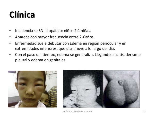 Sindrome Nefrótico y Nefrítico en Pediatría