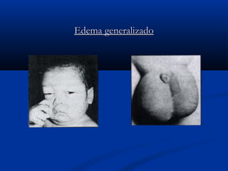 Edema generalizadoEdema generalizado
 