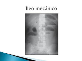 Sindrome oclusivo intestinal