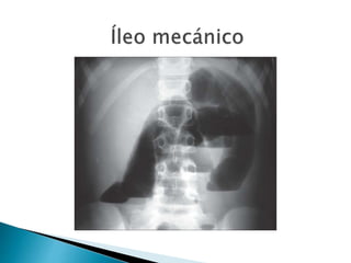 Sindrome oclusivo intestinal