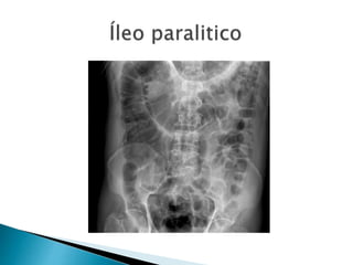 Sindrome oclusivo intestinal