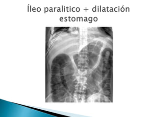 Sindrome oclusivo intestinal