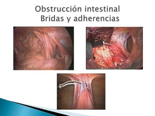 Sindrome oclusivo intestinal