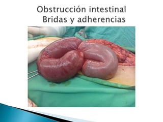 Sindrome oclusivo intestinal