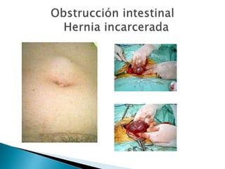 Sindrome oclusivo intestinal