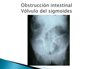 Sindrome oclusivo intestinal