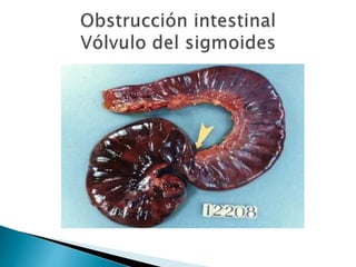 Sindrome oclusivo intestinal