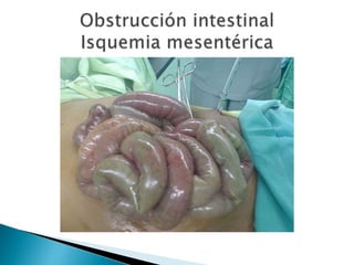 Sindrome oclusivo intestinal