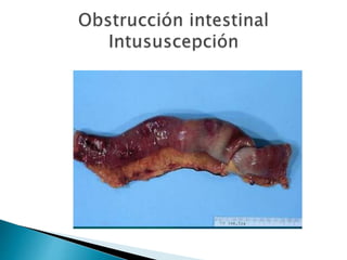 Sindrome oclusivo intestinal