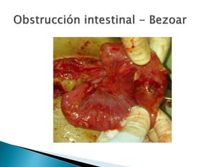 Sindrome oclusivo intestinal