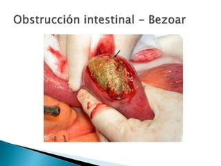 Sindrome oclusivo intestinal