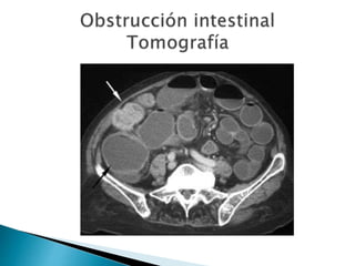 Sindrome oclusivo intestinal