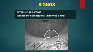 SIGNOS
●Inyección conjuntival
●Escaso menisco lagrimal (menor de 1 mm)
 