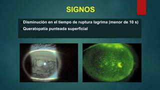 SIGNOS
●Disminución en el tiempo de ruptura lagrima (menor de 10 s)
●Queratopatía punteada superficial
 
