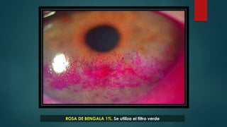 ROSA DE BENGALA 1%. Se utiliza el filtro verde
 