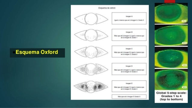 Sindrome De Ojo Seco Sindrome De Ojo Seco