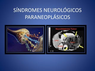 SÍNDROMES NEUROLÓGICOS
PARANEOPLÁSICOS
 