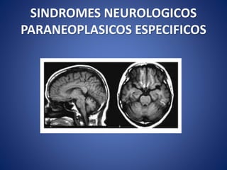 SINDROMES NEUROLOGICOS
PARANEOPLASICOS ESPECIFICOS
 
