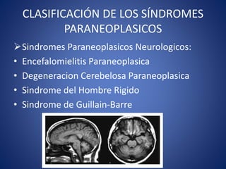CLASIFICACIÓN DE LOS SÍNDROMES
PARANEOPLASICOS
Sindromes Paraneoplasicos Neurologicos:
• Encefalomielitis Paraneoplasica
• Degeneracion Cerebelosa Paraneoplasica
• Sindrome del Hombre Rigido
• Sindrome de Guillain-Barre
 